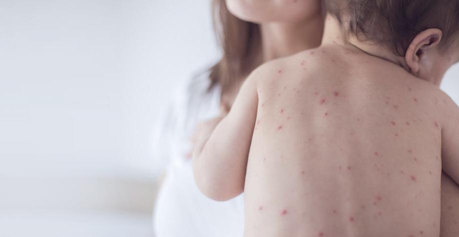 Кір – причини захворювання, симптоми та профілактика